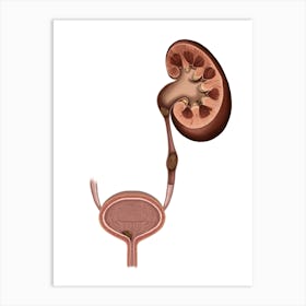 Kidney stones Art Print