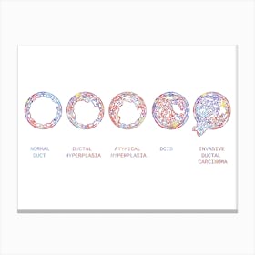 Normal Breast And Breast Cancer Types Watercolor Canvas Print